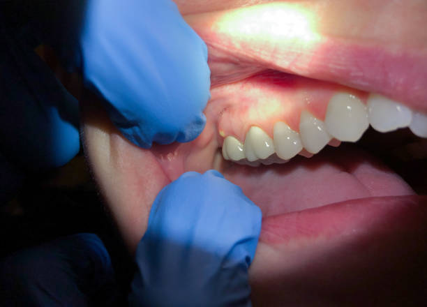 Best Emergency Treatment for Dental Infections or Abscesses in Yelm, WA