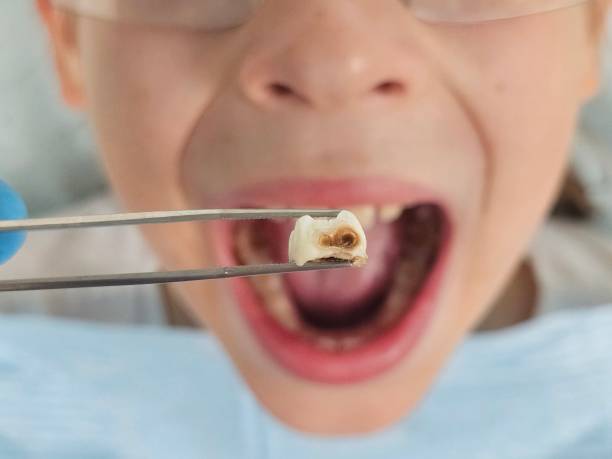 Best Emergency Dental Care for Broken or Chipped Teeth in Yelm, WA